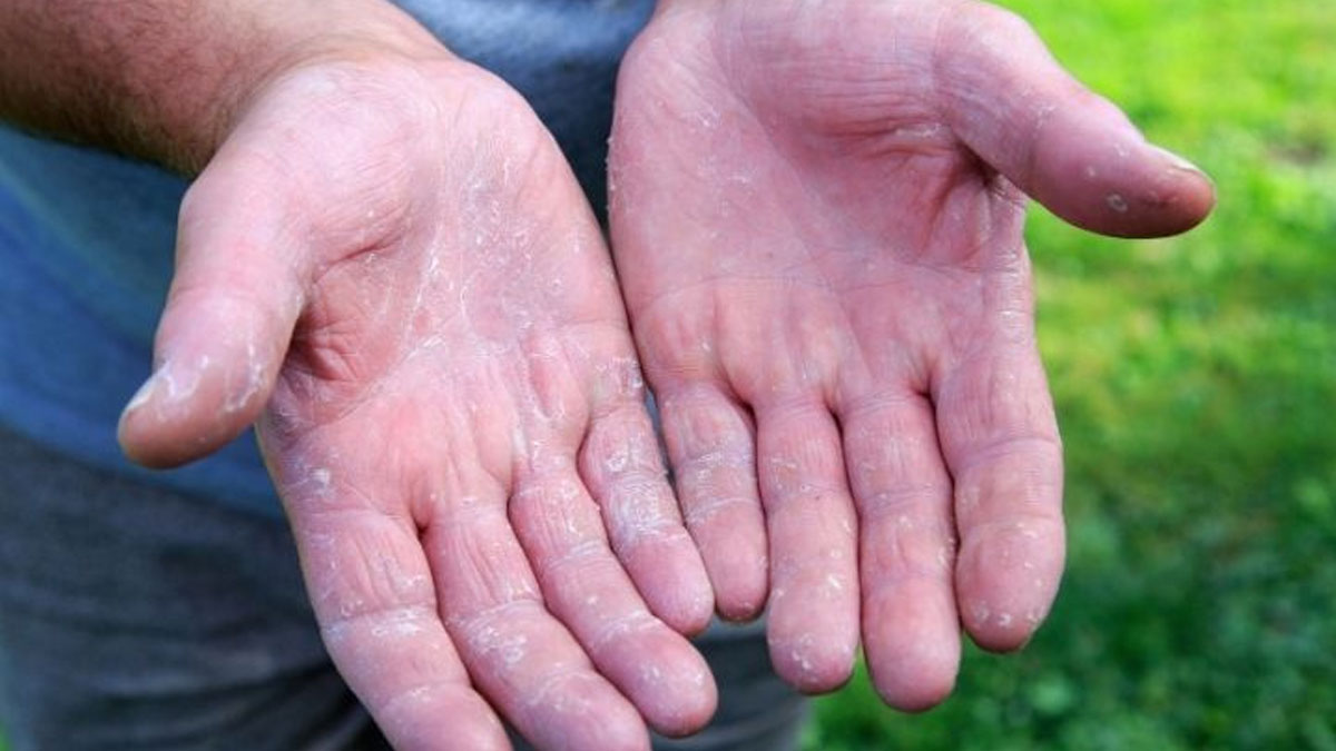 Bilim insanlarından çığır açan keşif: Egzamanın nedeni bulundu